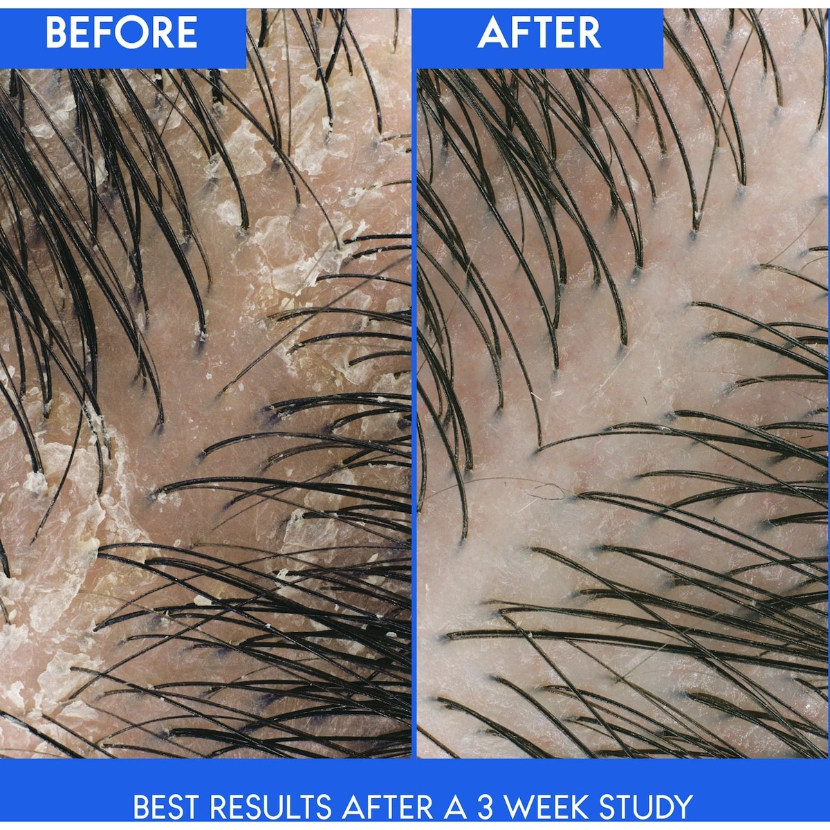 Shampooing pour cuir chevelu qui démange Head & Shoulders