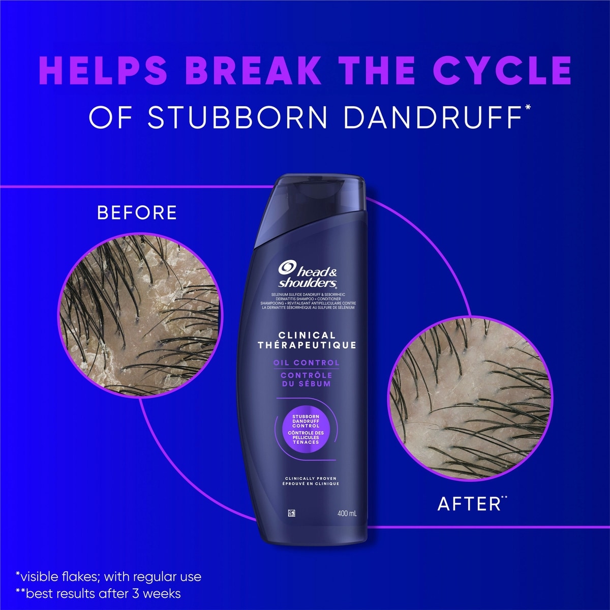 Head & Shoulders Clinical Dandruff Defense + Advanced Oil Control Shampoo, 400 mL