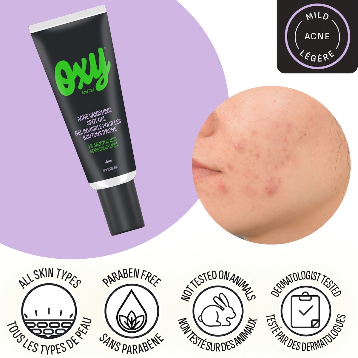 Traitement d'urgence en gel anti-acné avec acide salicylique, pour l'acné enflammée