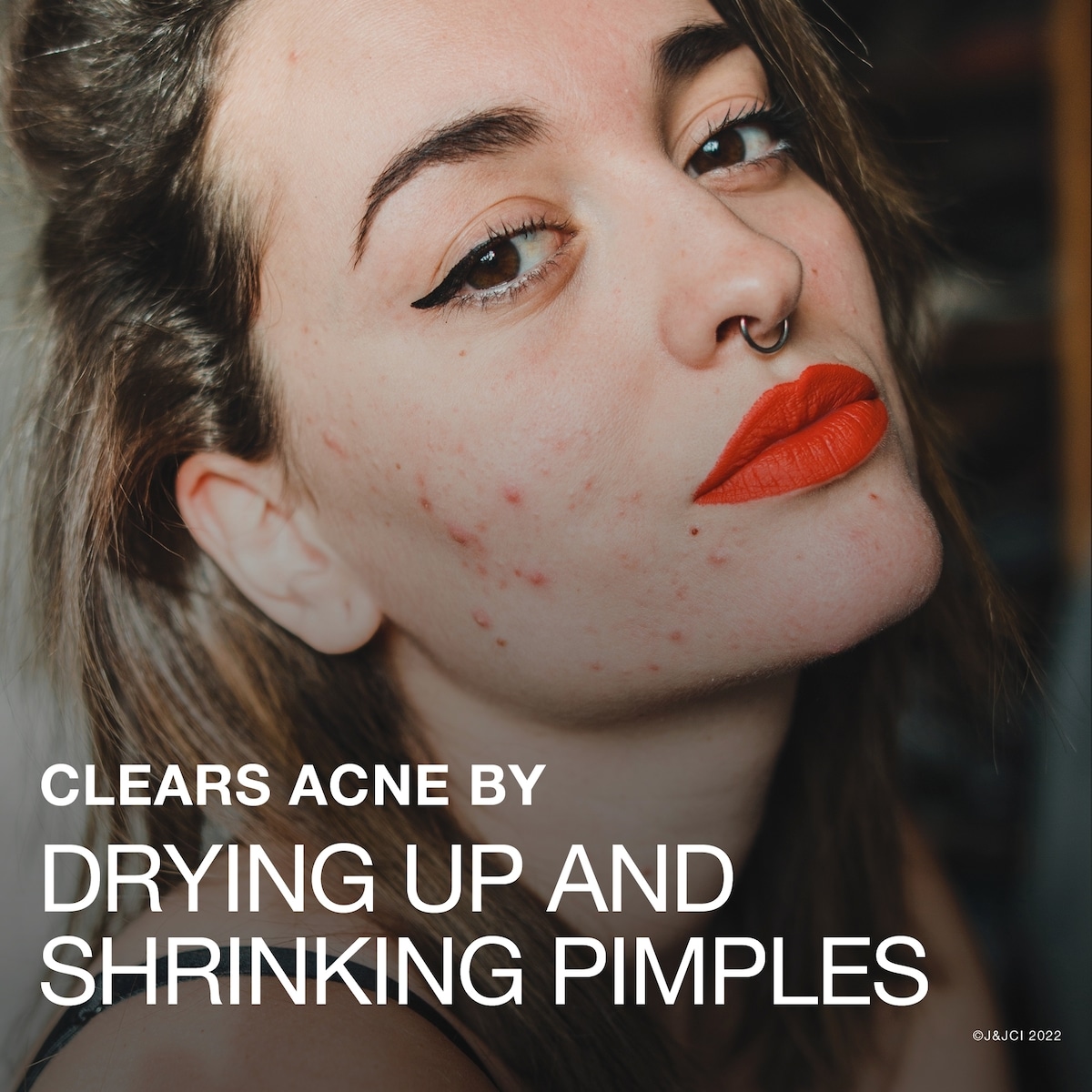 Stubborn Acne Drying Lotion