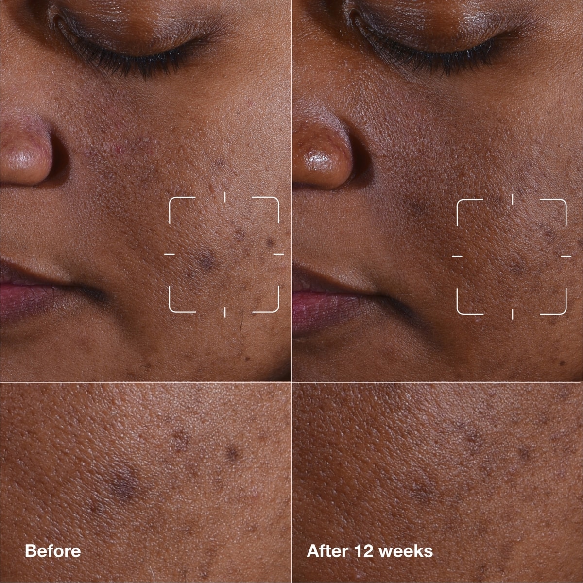 Sérum éclaircissant pour taches brunes Even Better Clinical™ avec vitamine C