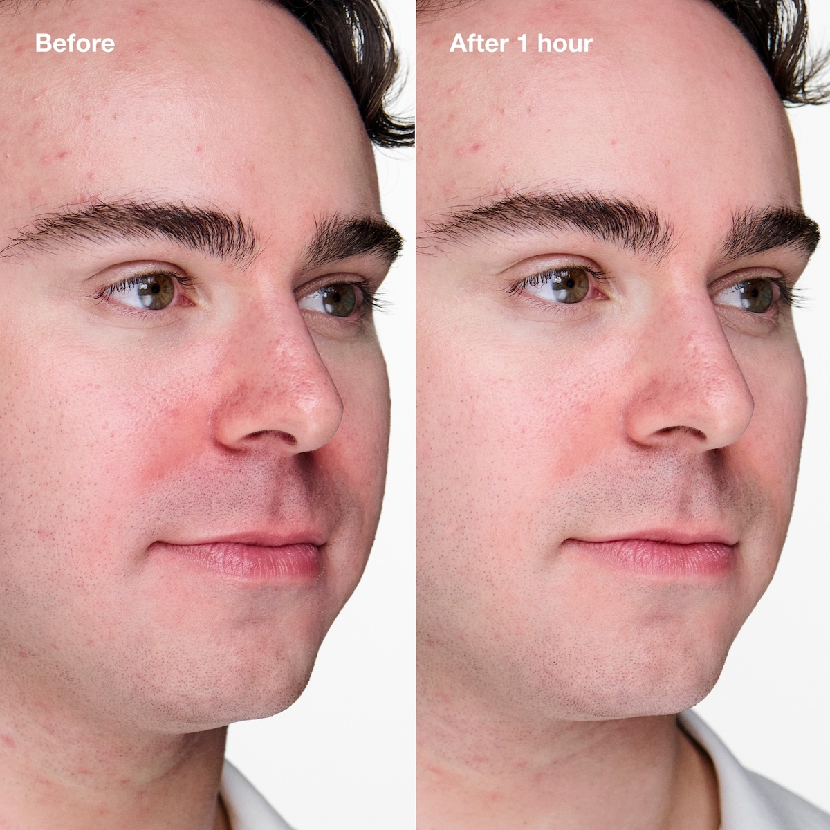 Acne Solutions Clinical Advanced Clearing Gel with Salicylic Acid