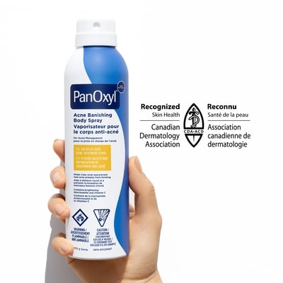 Acne Banishing Body Spray with 2% Salicylic Acid 2