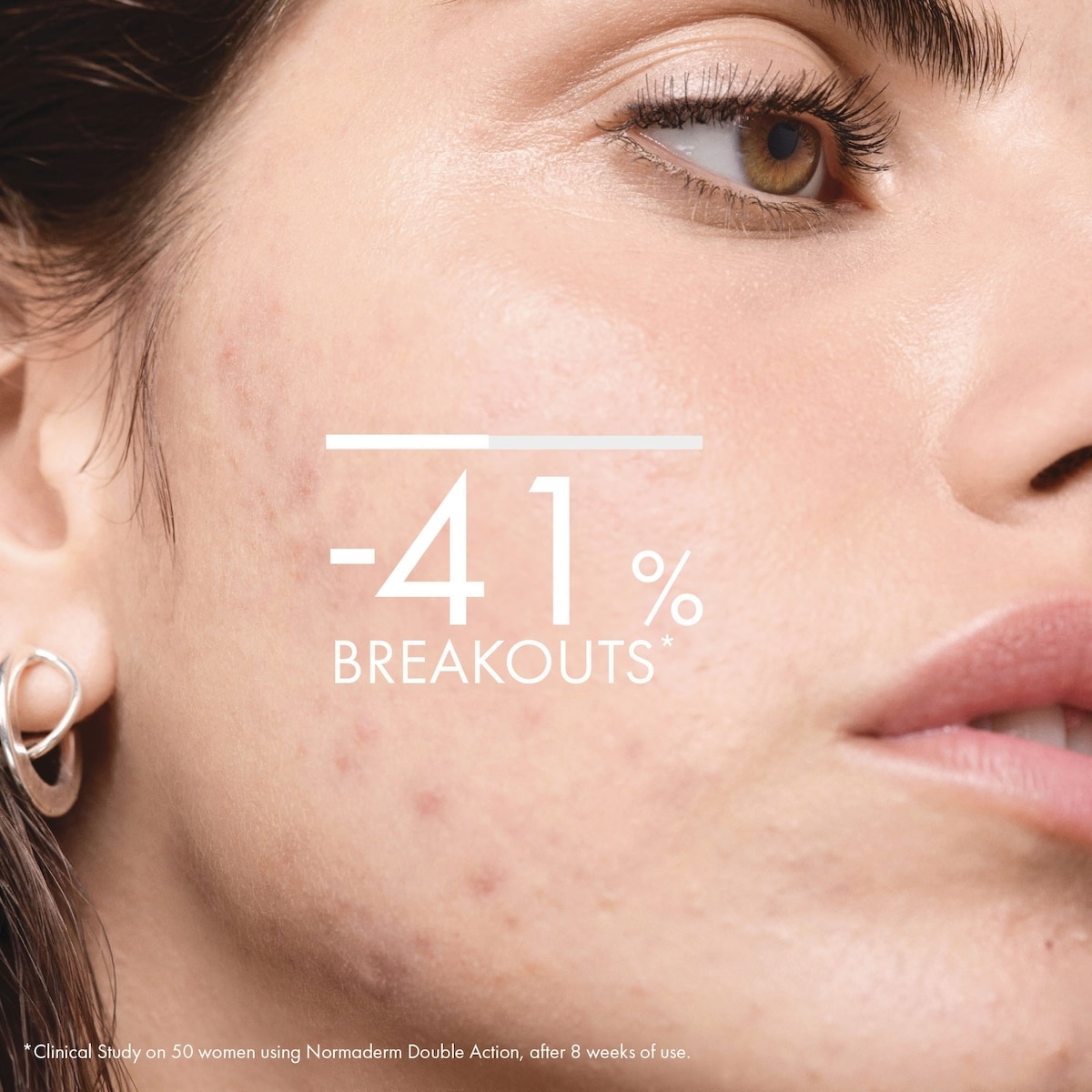 VICHY Normaderm Anti-Acne Hydrating Double Action Lotion