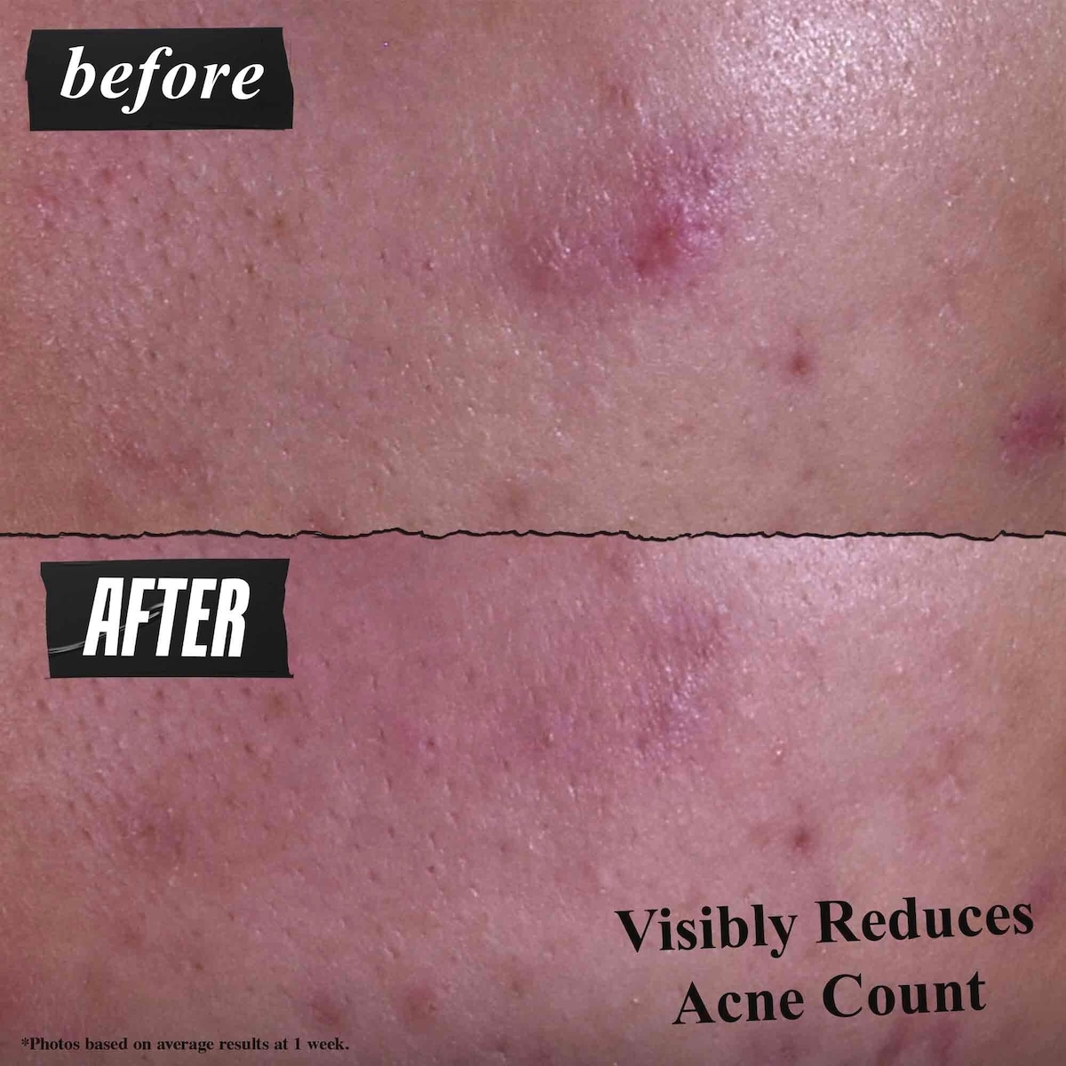 Gently Effective Acne-Treating Cleanser