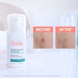 Cleanance Comedomed+ Intensive Anti-Blemish Care - for Pimples, Blackheads, Marks - Oily acne-prone skin 6