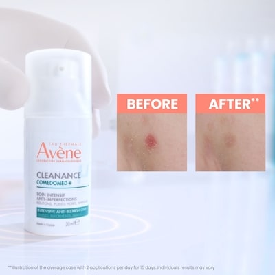Cleanance Comedomed+ Intensive Anti-Blemish Care - for Pimples, Blackheads, Marks - Oily acne-prone skin 6