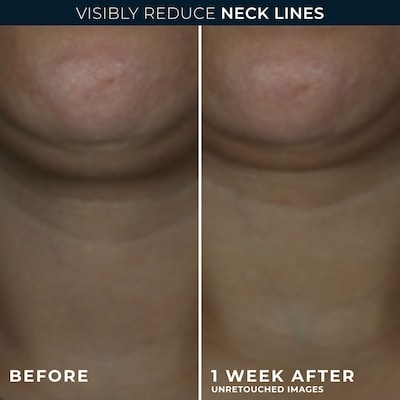 Derm Correxion® Neck Cream With Hyaluronic Acid And Advanced Retinol To Visibly Tighten & Lift Horizontal Neck Lines, Facial Moisturiser To Contour Face, Neck And Jawline, 50Ml 4