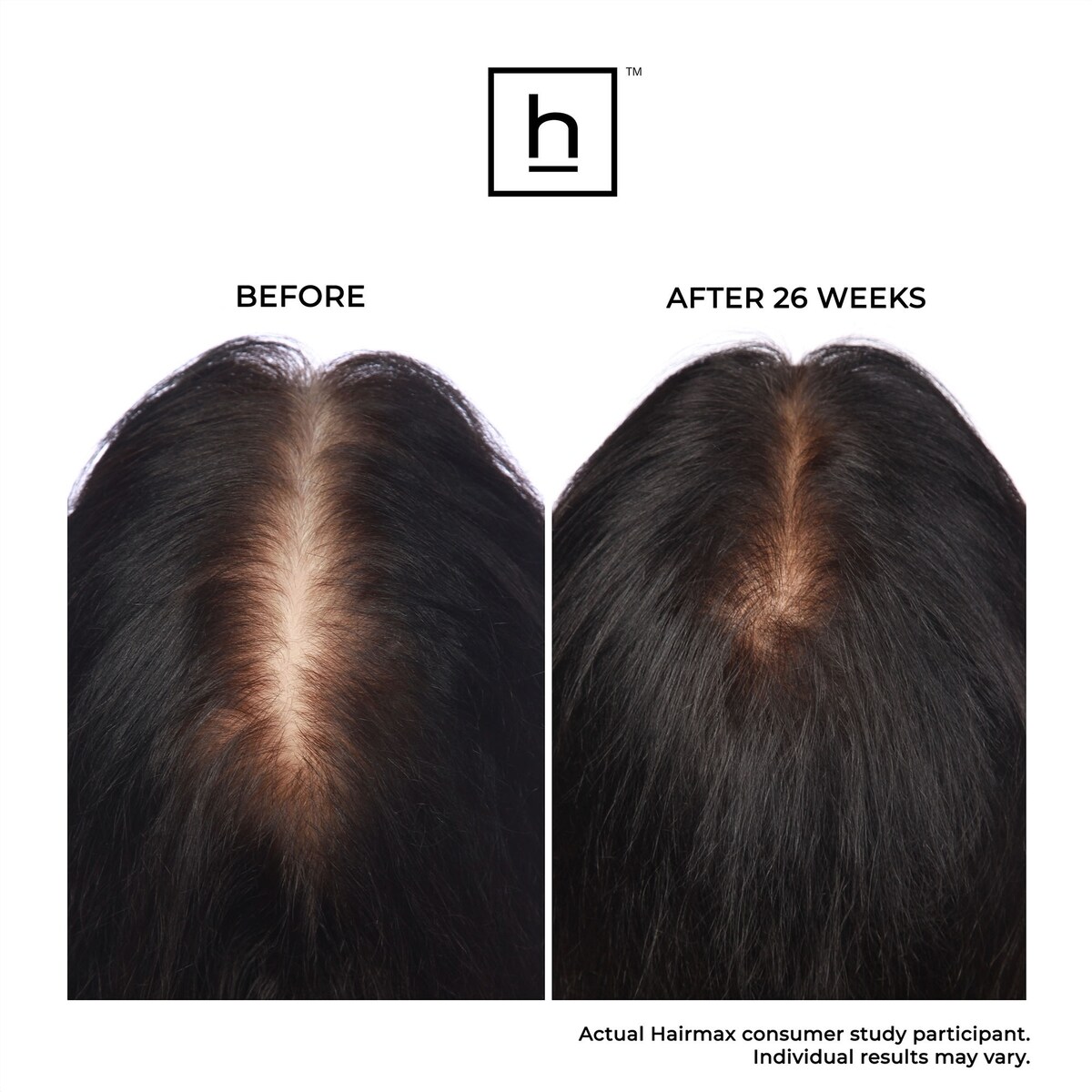 LaserBand 82 ComfortFlex