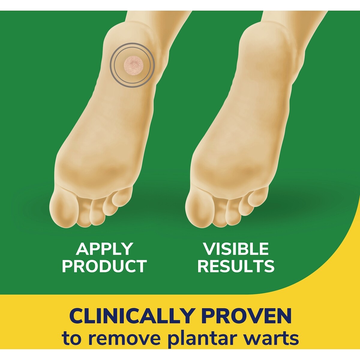 DS Traitement contre les verrues plantaires Clear Away